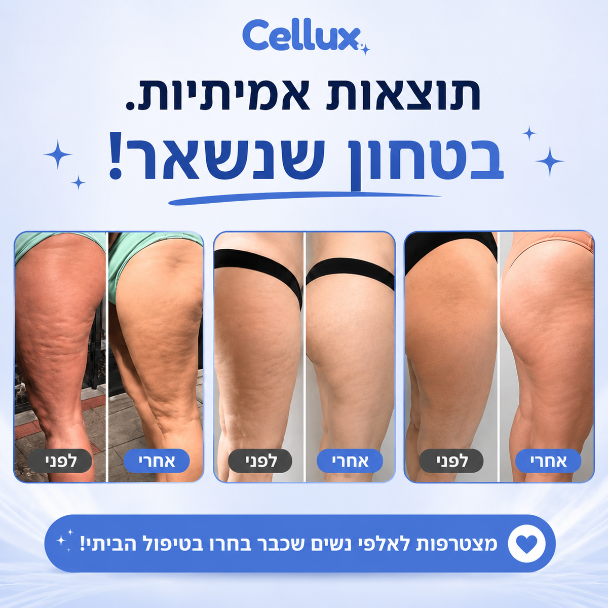 Cellux - ערכה ביתית לטיפול בצלוליט וסימני מתיחה